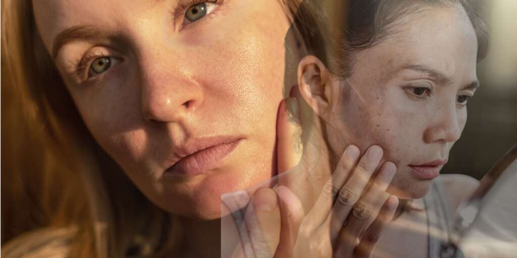 Melasma vs. Pigmentation: Understanding the Difference